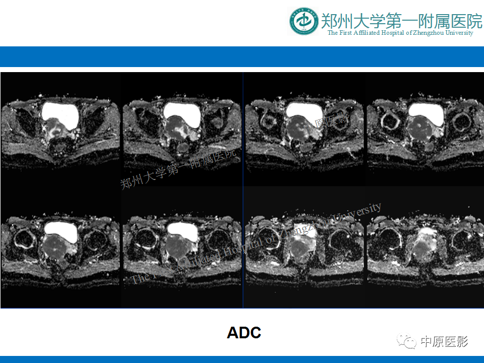 【病例】前列腺滑膜肉瘤1例MR影像-8