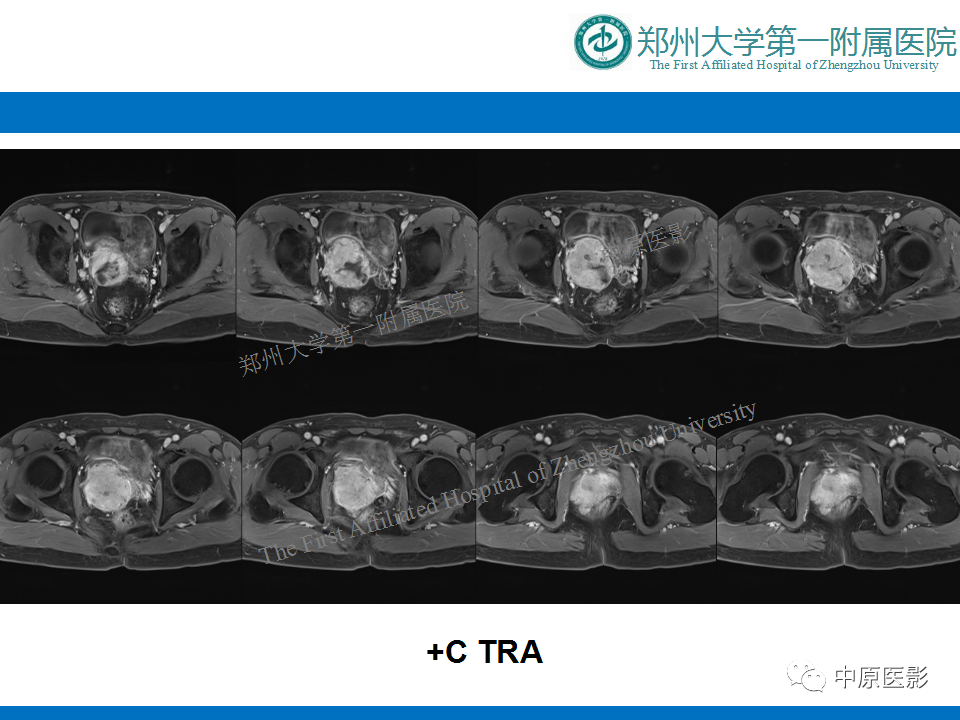 【病例】前列腺滑膜肉瘤1例MR影像-9