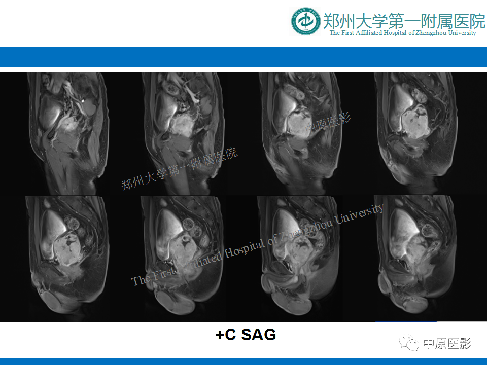 【病例】前列腺滑膜肉瘤1例MR影像-10