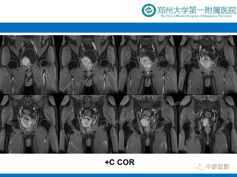 【病例】前列腺滑膜肉瘤1例MR影像-11