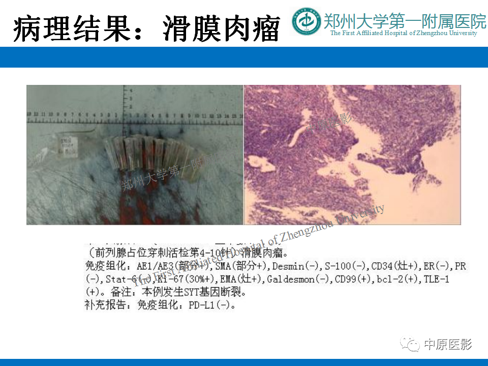 【病例】前列腺滑膜肉瘤1例MR影像-13
