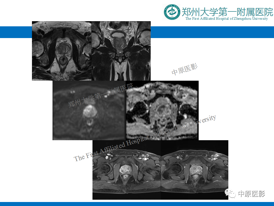 【病例】前列腺滑膜肉瘤1例MR影像-18