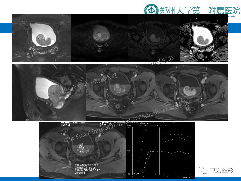 【病例】前列腺滑膜肉瘤1例MR影像-20