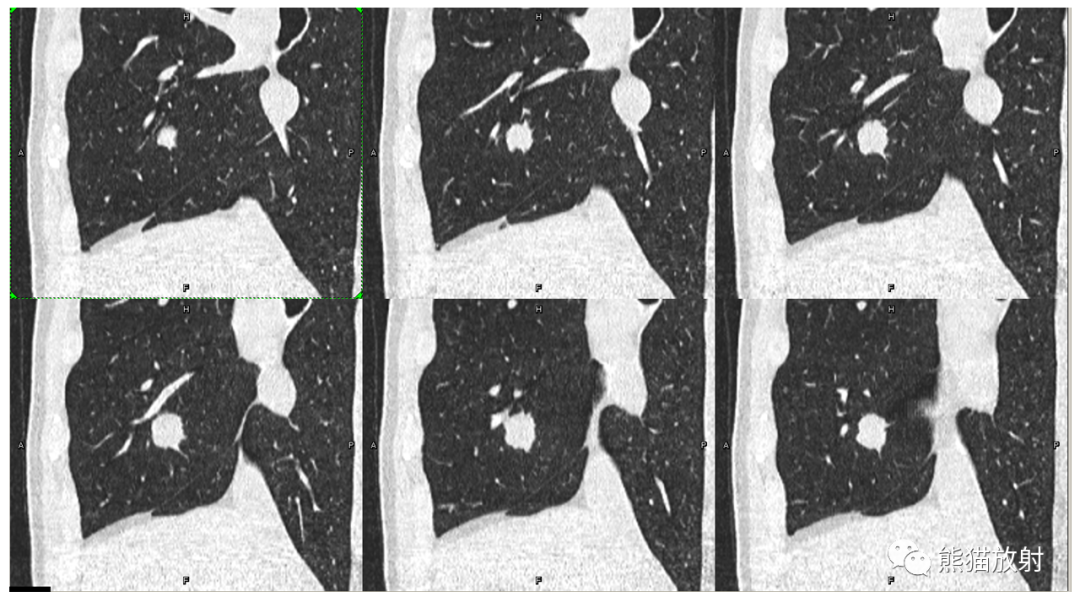 【病例】肺腺癌 VS 炎性肌纤维母细胞瘤-5