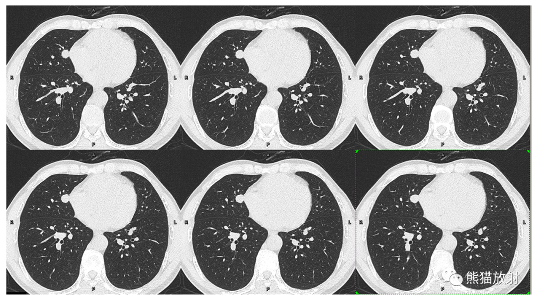 【病例】肺腺癌 VS 炎性肌纤维母细胞瘤-4