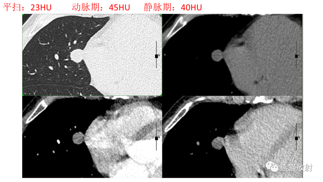 【病例】肺腺癌 VS 炎性肌纤维母细胞瘤-6