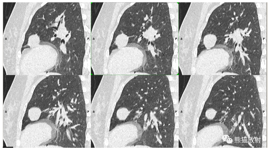 【病例】肺腺癌 VS 炎性肌纤维母细胞瘤-11