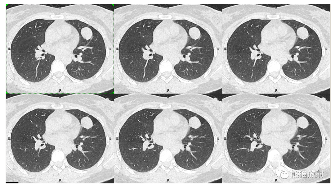 【病例】肺腺癌 VS 炎性肌纤维母细胞瘤-10
