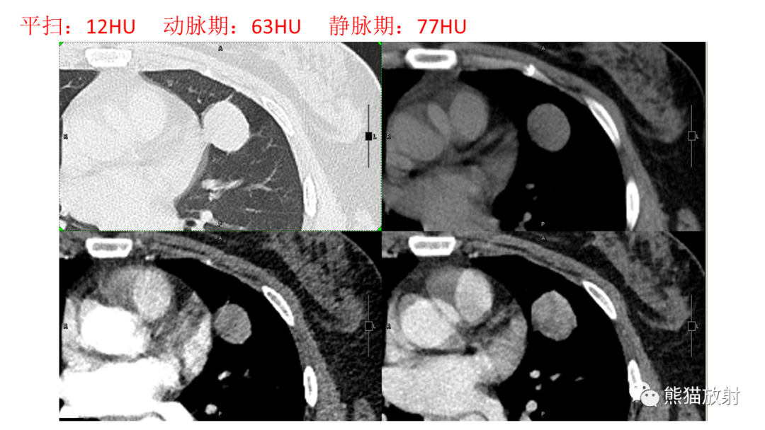 【病例】肺腺癌 VS 炎性肌纤维母细胞瘤-12