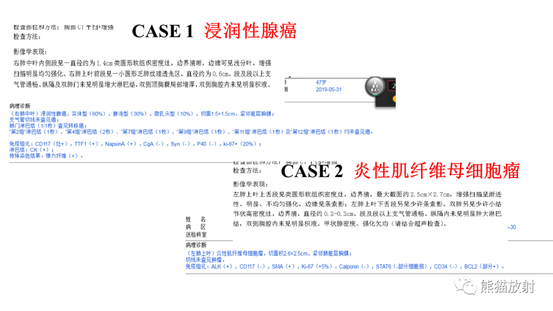 【病例】肺腺癌 VS 炎性肌纤维母细胞瘤-14