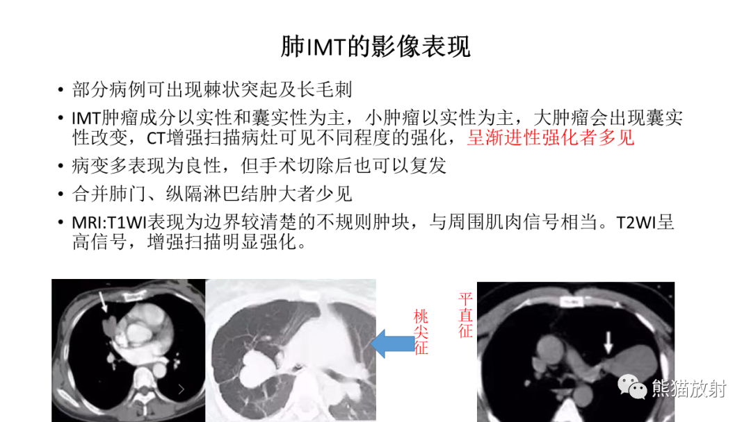 【病例】肺腺癌 VS 炎性肌纤维母细胞瘤-23