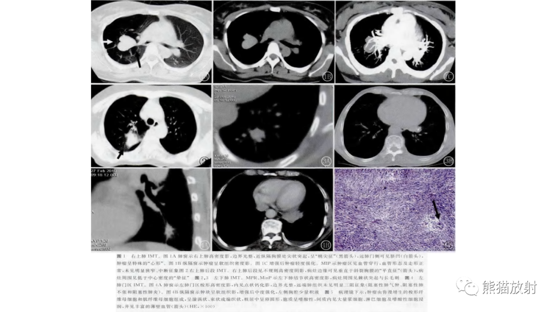 【病例】肺腺癌 VS 炎性肌纤维母细胞瘤-24