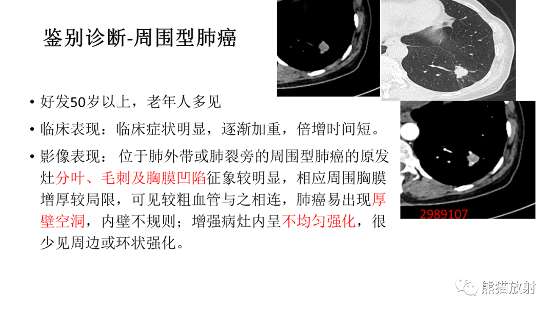 【病例】肺腺癌 VS 炎性肌纤维母细胞瘤-27