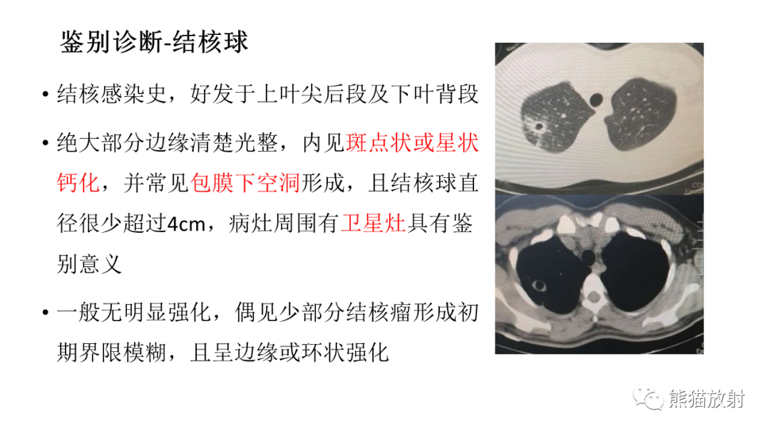 【病例】肺腺癌 VS 炎性肌纤维母细胞瘤-29