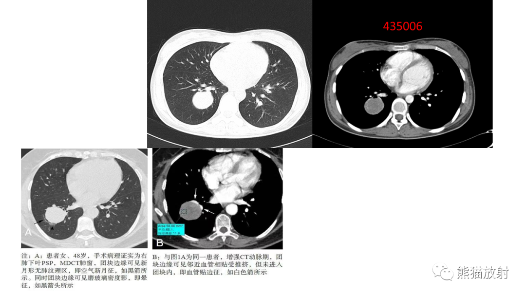 【病例】肺腺癌 VS 炎性肌纤维母细胞瘤-31