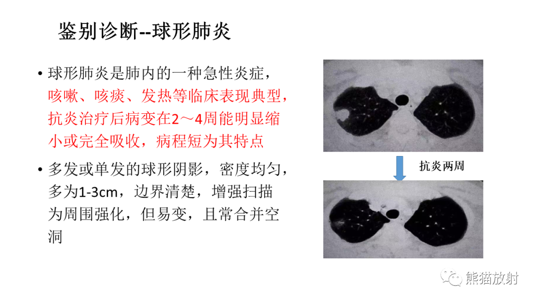 【病例】肺腺癌 VS 炎性肌纤维母细胞瘤-32