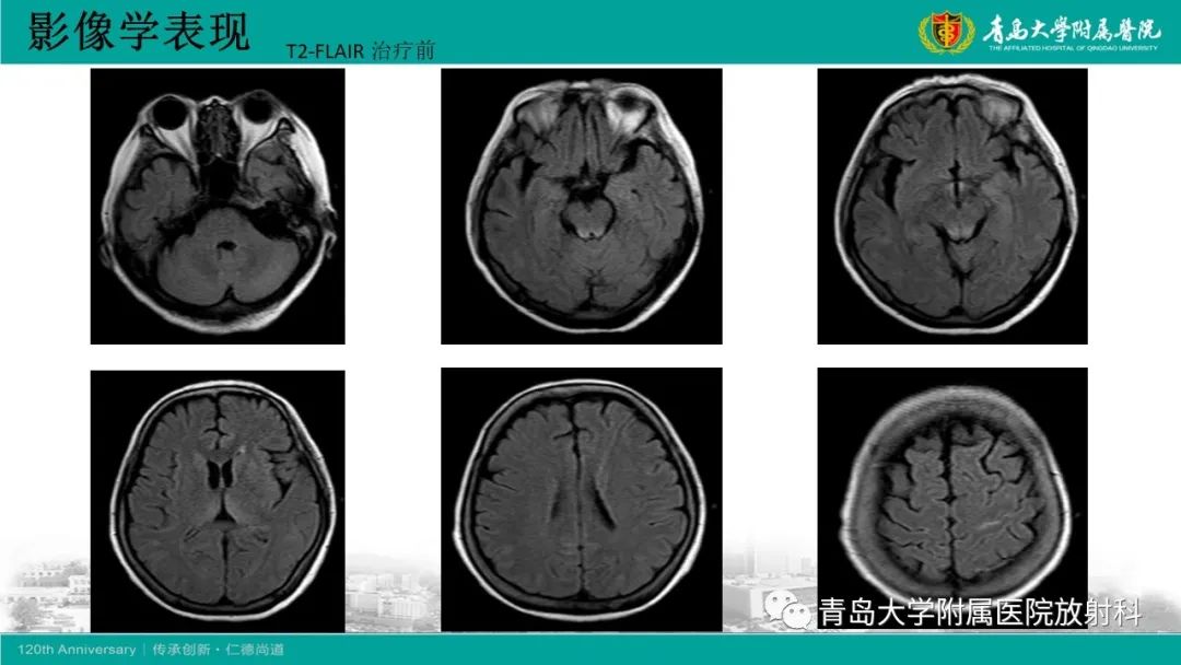 【病例】Wernicke脑病1例MR影像-5
