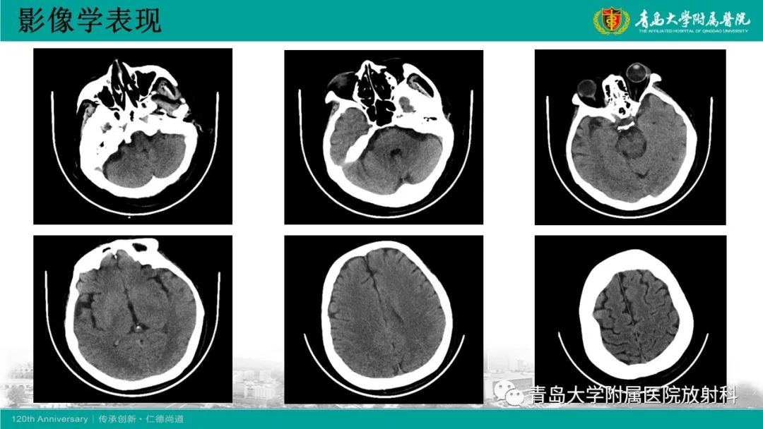 【病例】Wernicke脑病1例MR影像-4