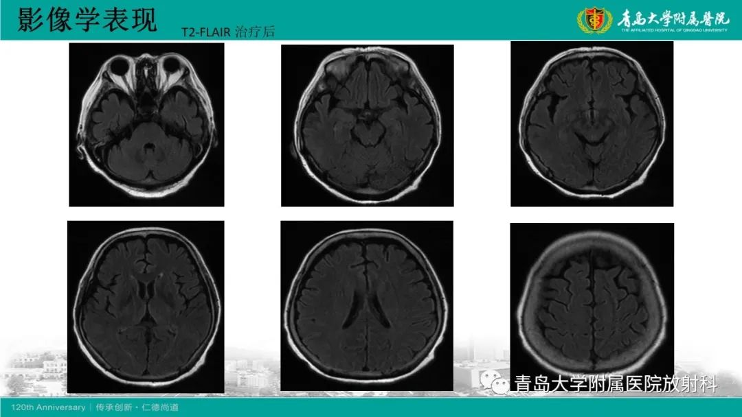 【病例】Wernicke脑病1例MR影像-6