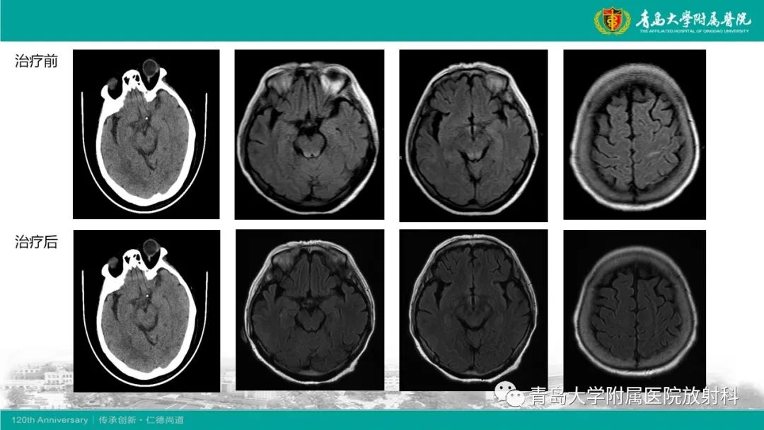 【病例】Wernicke脑病1例MR影像-13