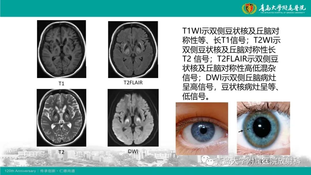 【病例】Wernicke脑病1例MR影像-19