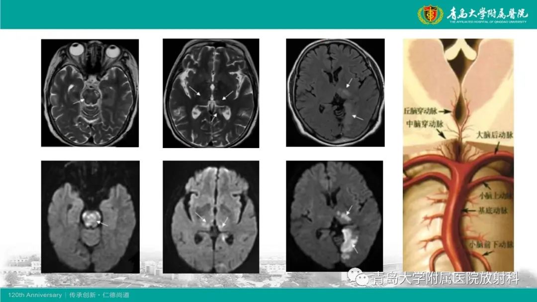 【病例】Wernicke脑病1例MR影像-21