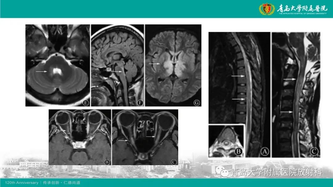 【病例】Wernicke脑病1例MR影像-23