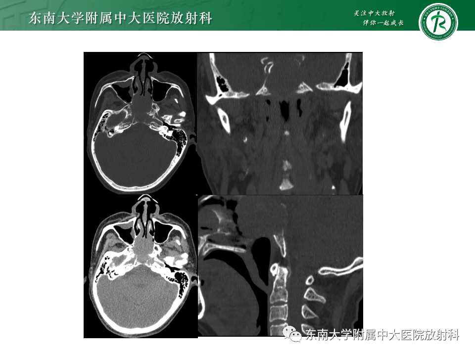【PPT】斜坡骨质破坏性病变影像诊断-5