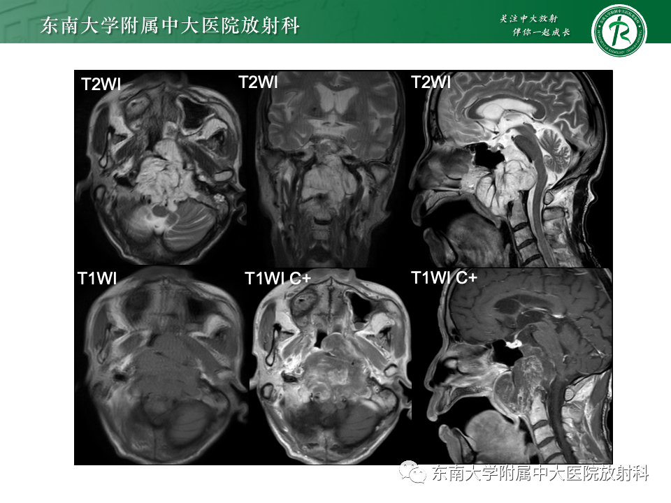 【PPT】斜坡骨质破坏性病变影像诊断-3