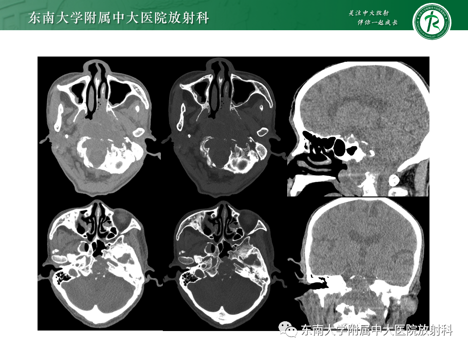 【PPT】斜坡骨质破坏性病变影像诊断-2