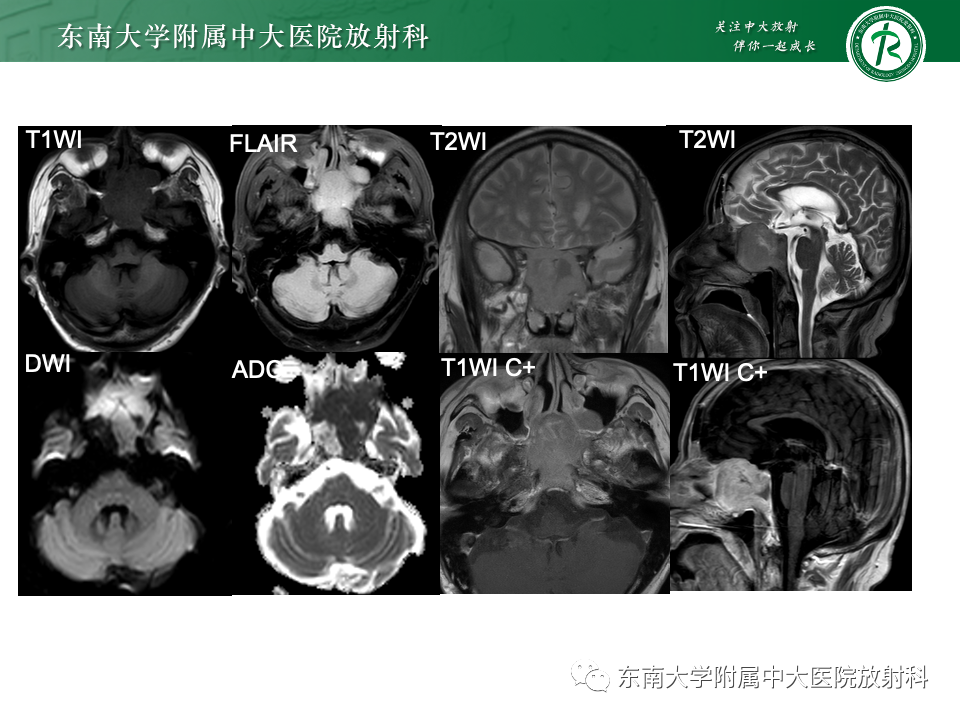 【PPT】斜坡骨质破坏性病变影像诊断-6