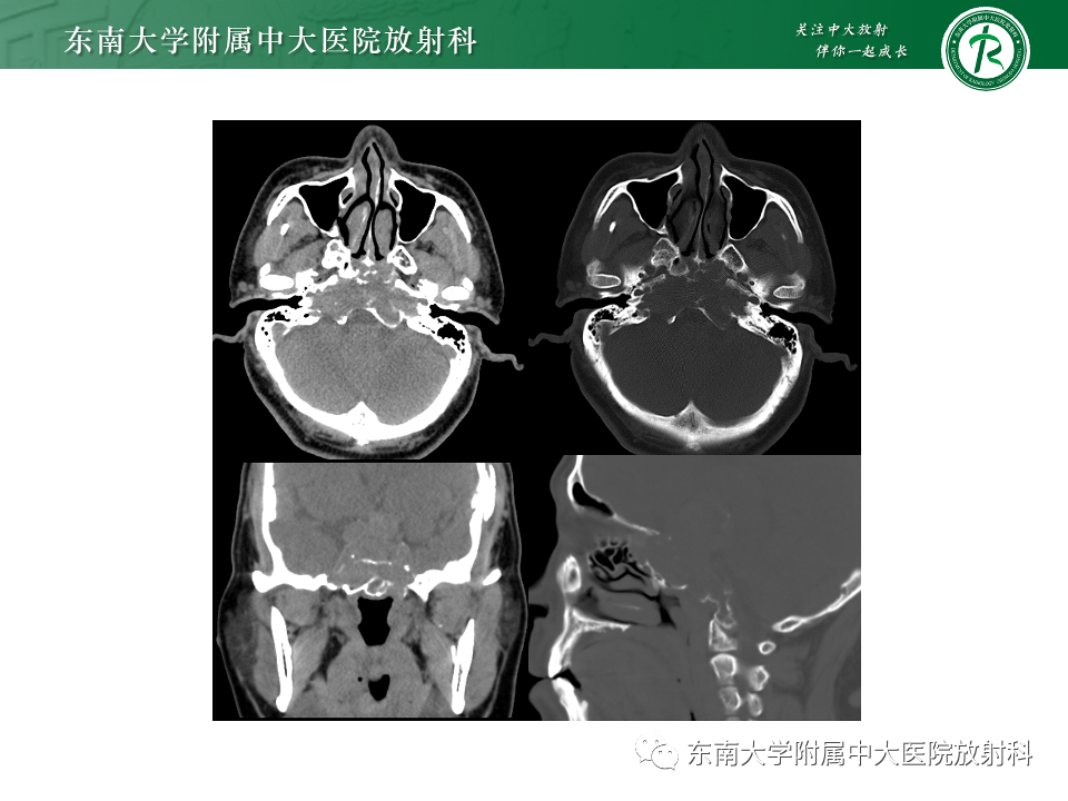【PPT】斜坡骨质破坏性病变影像诊断-8
