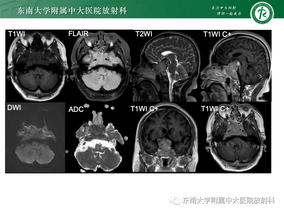 【PPT】斜坡骨质破坏性病变影像诊断-9