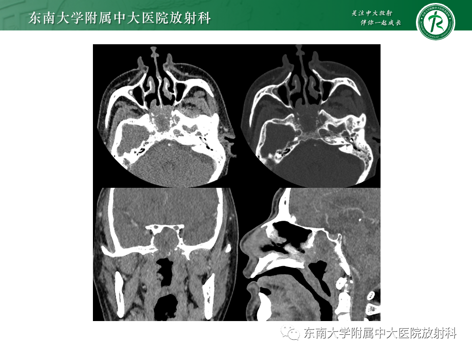 【PPT】斜坡骨质破坏性病变影像诊断-11