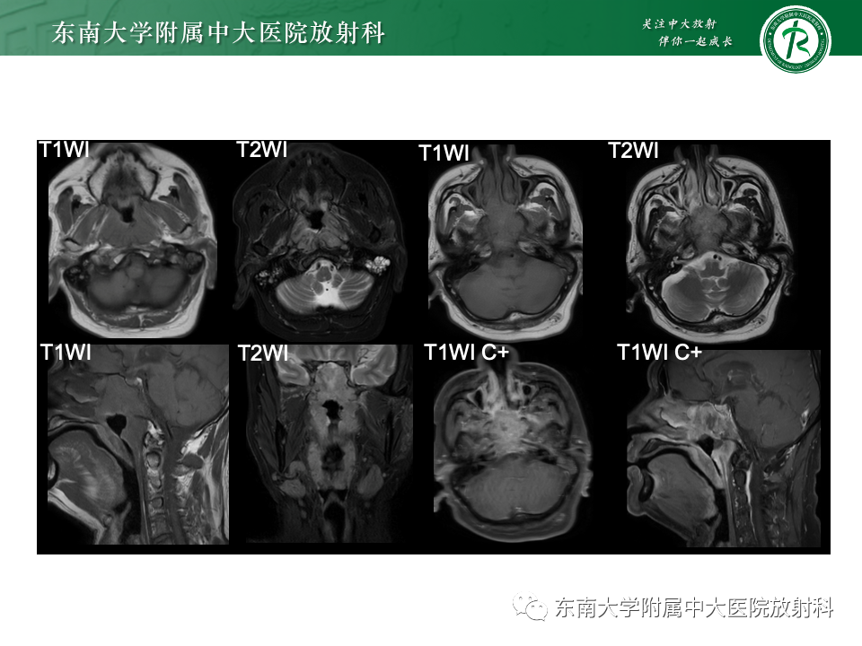【PPT】斜坡骨质破坏性病变影像诊断-12