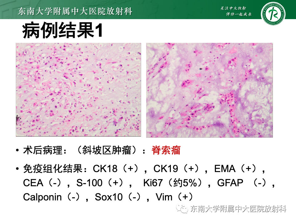 【PPT】斜坡骨质破坏性病变影像诊断-13