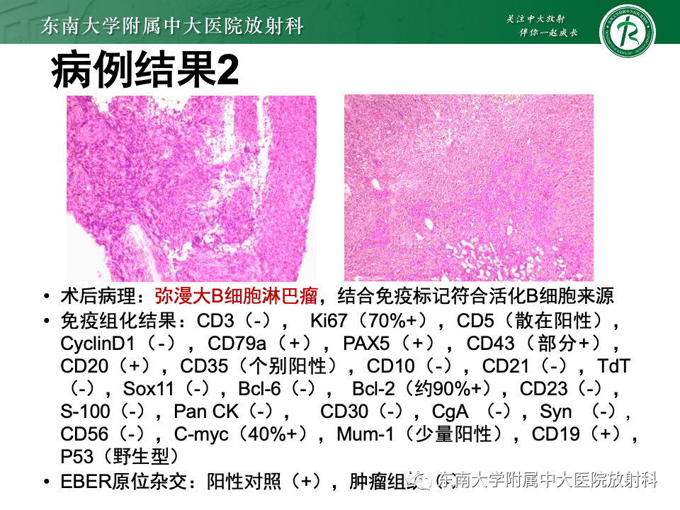 【PPT】斜坡骨质破坏性病变影像诊断-14