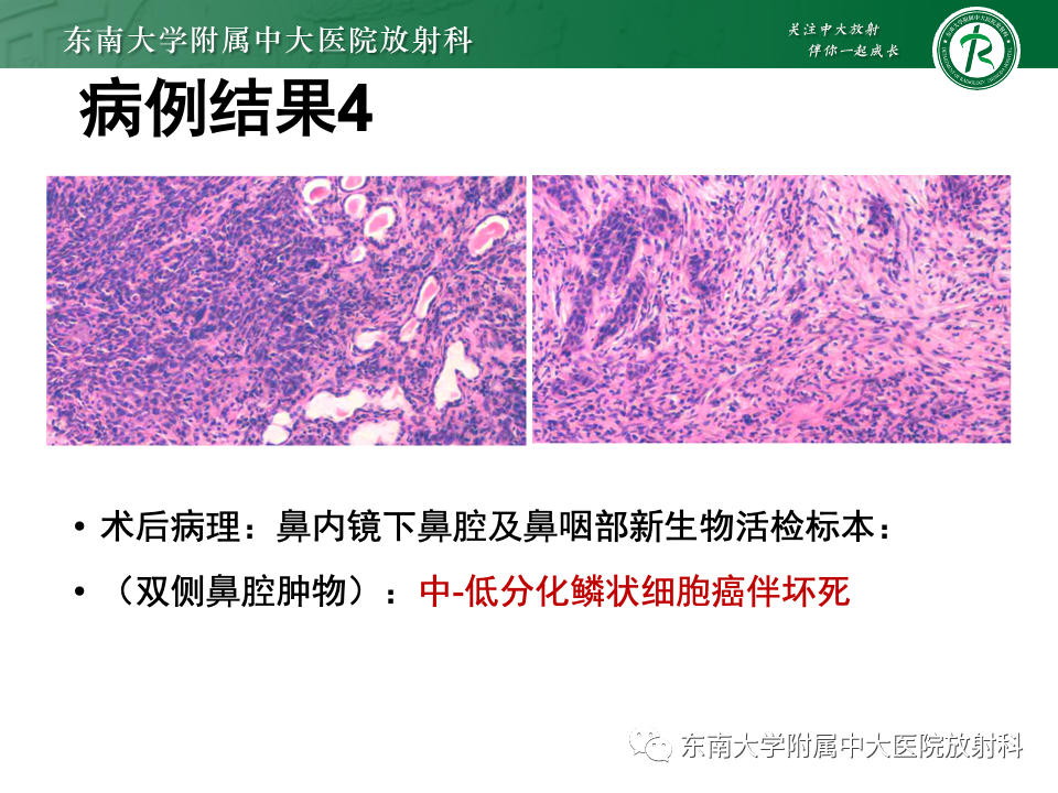 【PPT】斜坡骨质破坏性病变影像诊断-17