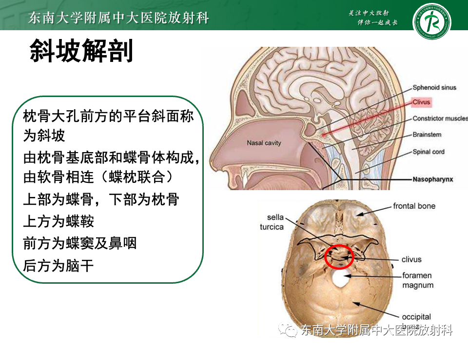 【PPT】斜坡骨质破坏性病变影像诊断-22