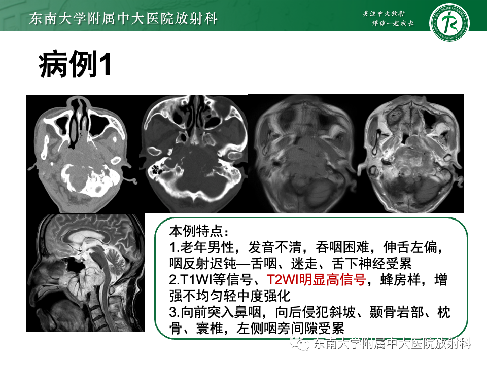 【PPT】斜坡骨质破坏性病变影像诊断-28