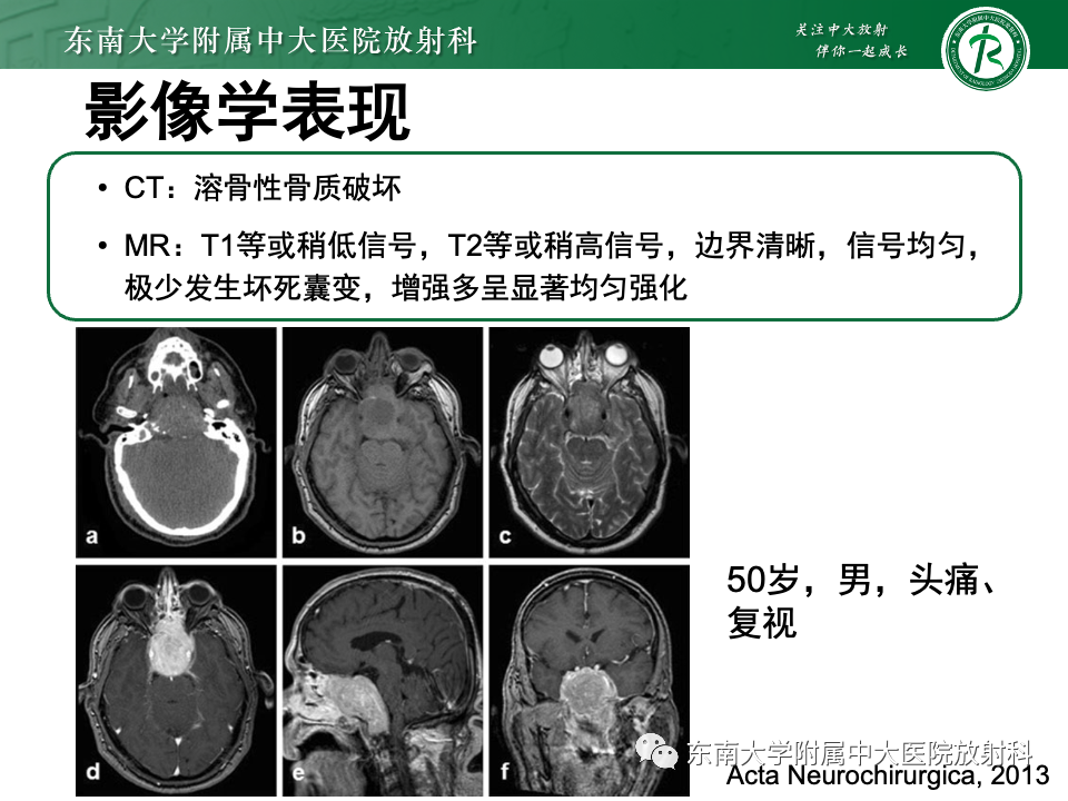 【PPT】斜坡骨质破坏性病变影像诊断-30