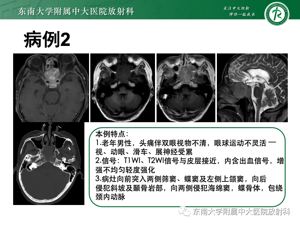【PPT】斜坡骨质破坏性病变影像诊断-34