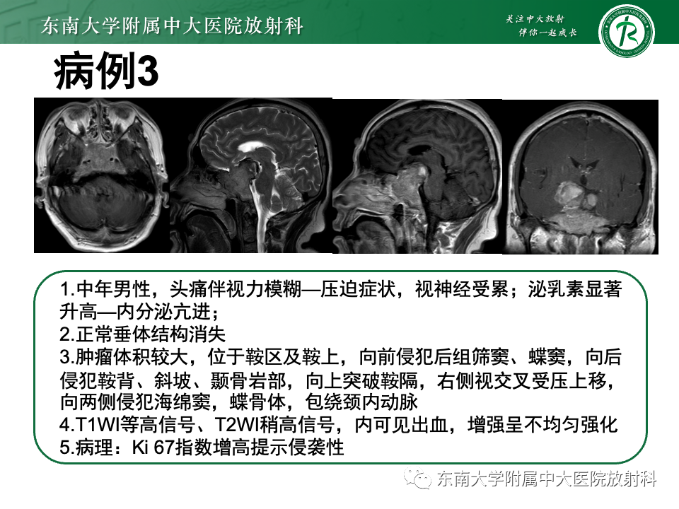 【PPT】斜坡骨质破坏性病变影像诊断-39