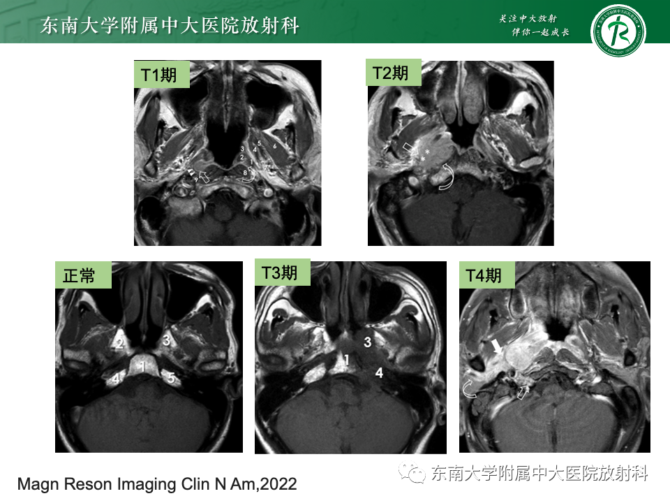 【PPT】斜坡骨质破坏性病变影像诊断-43
