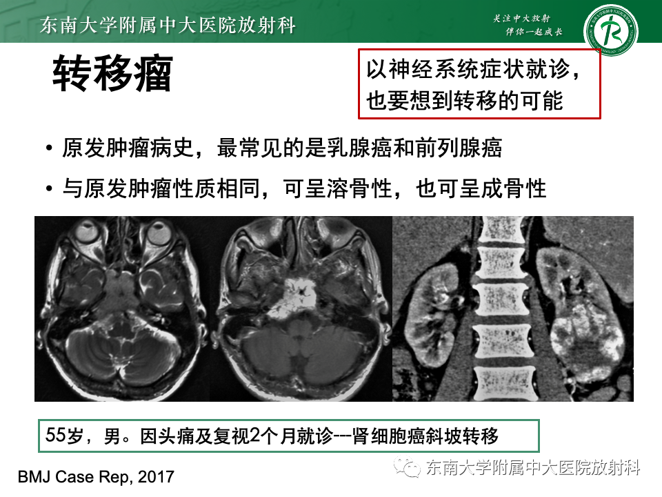 【PPT】斜坡骨质破坏性病变影像诊断-48