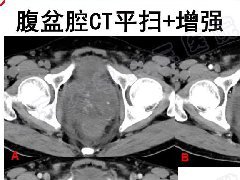 前列腺肉瘤