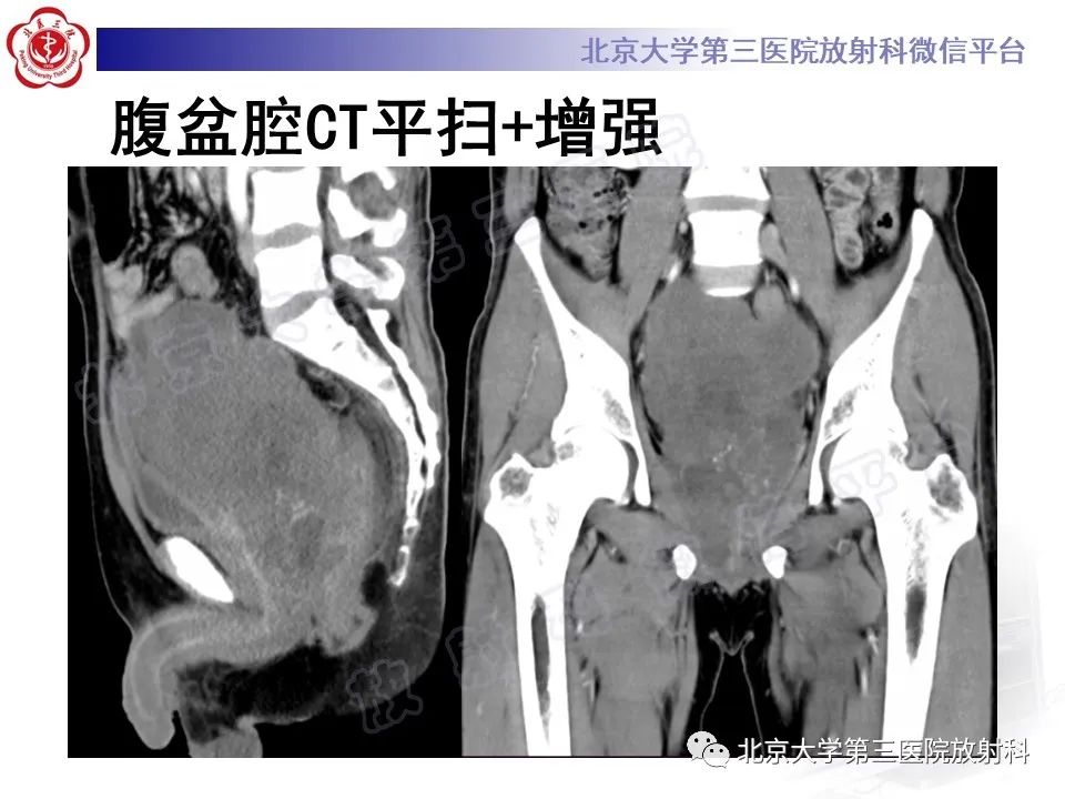 【PPT】前列腺肉瘤-5
