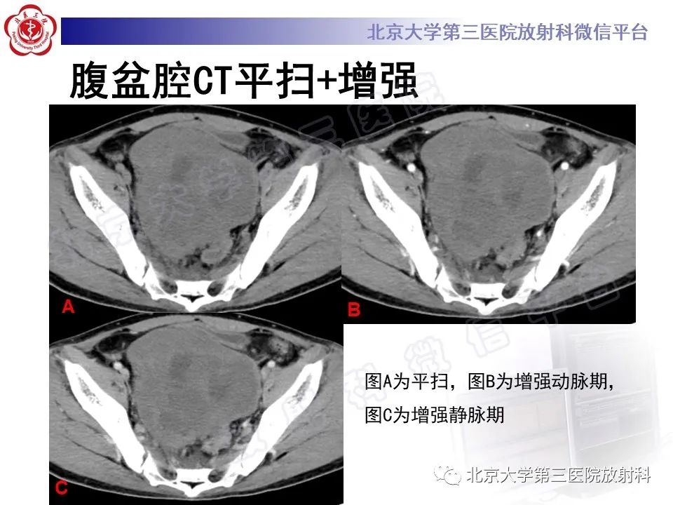 【PPT】前列腺肉瘤-4
