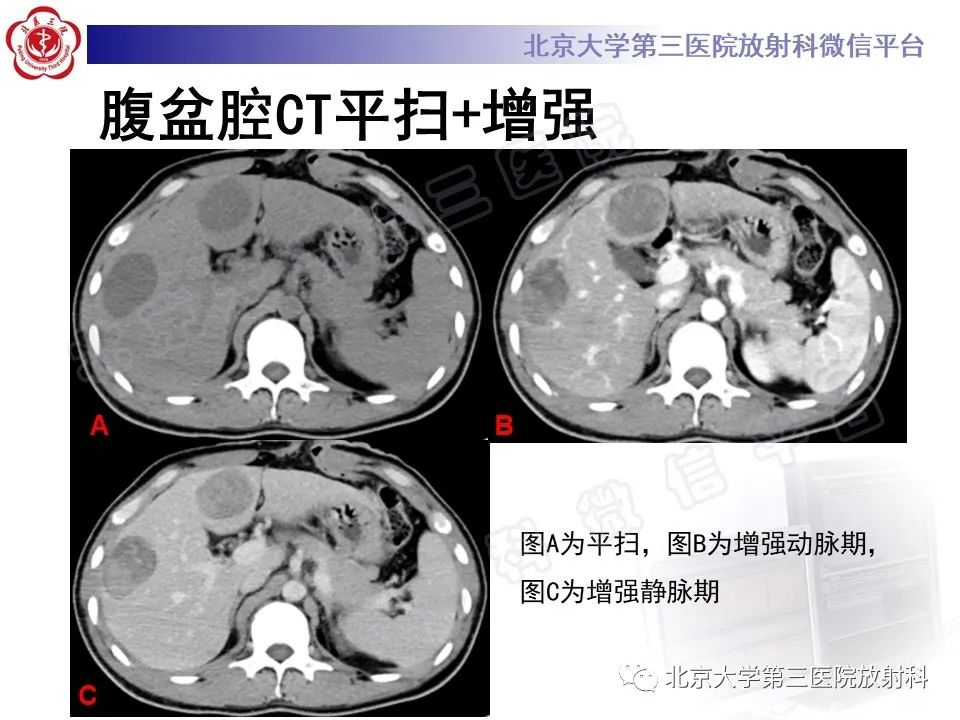 【PPT】前列腺肉瘤-6