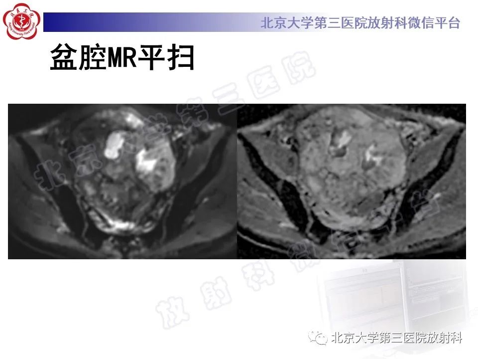 【PPT】前列腺肉瘤-9